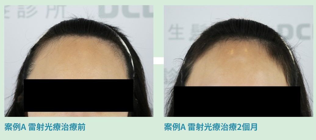 DCDC植髮手術雷射光療案例